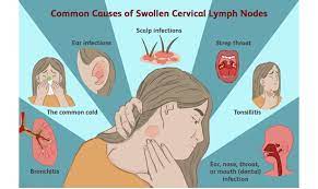 swollen lymph nodes and dental issues