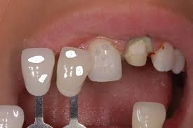 Dental Shade Determination How To Pick The Right Color
