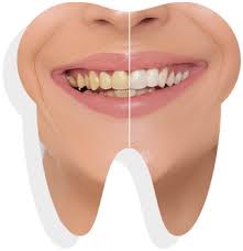 teeth whitening treatment allsmiles