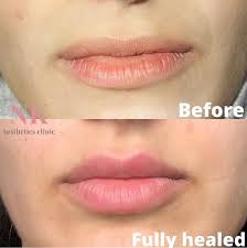 russian lip technique fully healed