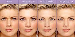 How long does it take for botox to work on forehead. Erase Your Age With Botox How Long Does It Take For Botox To Work