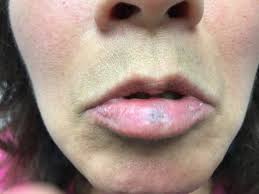 venous lake tumor on lip aesthetic