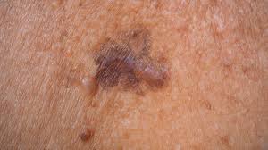 what skin cancer and precancer looks like