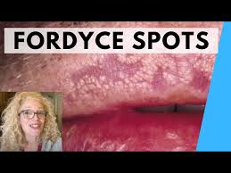 syringoma vs fordyce spots natural