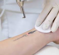 laser tattoo removal toronto botox