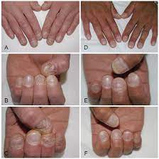 nail psoriasis an updated review and