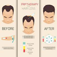 how prp for hair loss benefits patients
