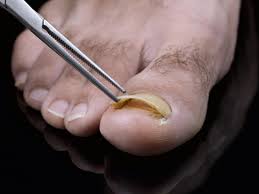 debris buildup under toenails toenail