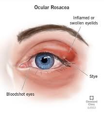 clear insights navigating ocular rosacea