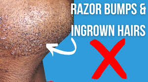 minimize razor ps and ingrown hairs