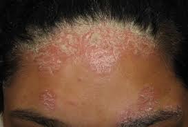 itchy rash on forehead causes