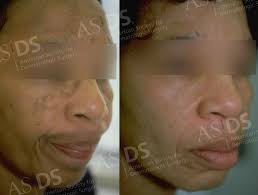 before left and after right melasma patient 4 months after jessner s chemical l