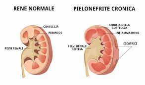 Pielonefrita este un proces infecţios inflamator nespecific. Pielonefrite Acuta E Cronica Differenze Urologo Andrologo Torino Dott Milan