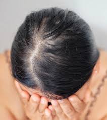 diffuse hair loss alopecia causes