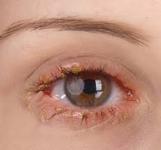 blepharitis bristol dry eyes newport