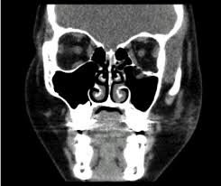 coronal ct imaging of a pediatric