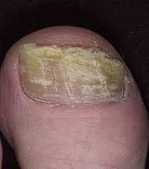 fungal nails why does the underside of