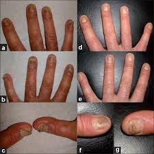 treatment of severe nail psoriasis with