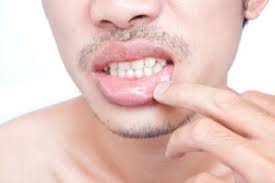 p inside lip mucous cyst causes