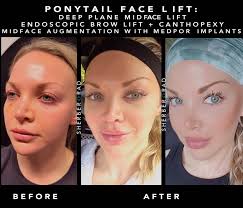 ponytail facelift surgery washington