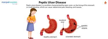 peptic ulcer disease