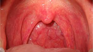 why do i have red spots on my throat