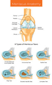 meniscus surgery alternative please