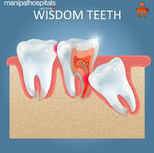 wisdom tooth pain challenges