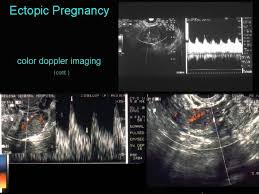 doppler findings in ectopic pregnancy