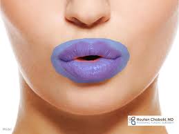 botox lip flip for fuller lips