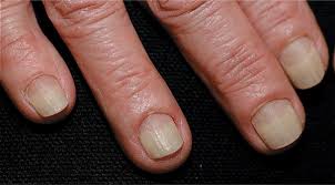 32 disorders of the nail apparatus