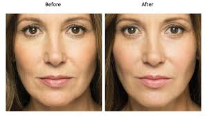 collagen induction therapy in delhi