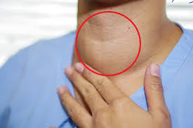 El istmo es un trozo delgado de tejido que conecta los dos lóbulos. Estos Sintomas Que Parecen Inofensivos Podrian Ser Senal De Cancer De Tiroides