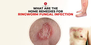 ringworm fungal infection