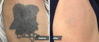 laser tattoo removal healing process