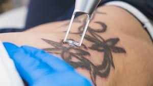 tattoo removal options and results fda