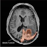 Image result for icd 10 code for history of meningioma resection