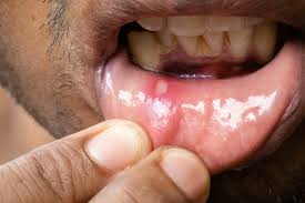 hiv and mouth sores what you need to know