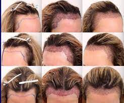 Some of the organic tresses are stiched or braided together to act. Hair Transplant à¤¹ à¤¯à¤° à¤Ÿ à¤° à¤¸à¤ª à¤² à¤Ÿ à¤¶à¤¨ à¤¬ à¤² à¤• à¤Ÿ à¤° à¤¸à¤ª à¤² à¤Ÿ à¤¶à¤¨ In Sector 8 C Hair Transplanters Id 20843803933