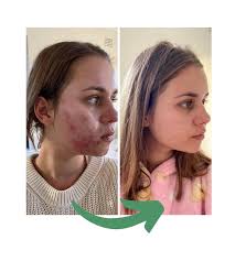 fixing hormonal chin acne naturally
