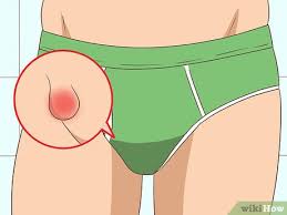 3 ways to treat chigger bites wikihow