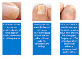 psoriatic nails relieve the patient
