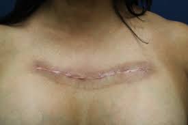 international keloid scar treatment