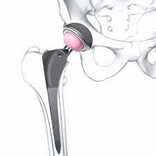 Prótesis de cadera de primera intención - Bicontact&reg; - Aesculap® - cementada o no cementada