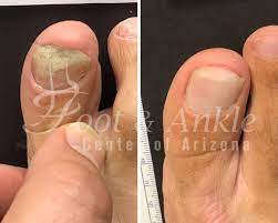 toenail fungus prevention and treatment