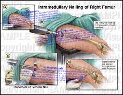 intramedullary nailing rodding of