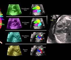 color doppler ultrasound third