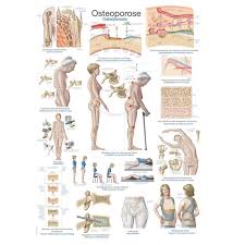 Osteoporosis Educational Chart