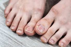 broken ingrown ugly toenails sloppy