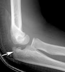 Repeating certain types of activities over and over again can put too much strain on the tendons around the medial epicondyle (bone that protrudes on the inside of the elbow). Clinical Practice Guidelines Medial Epicondyle Fracture Of The Humerus Emergency Department